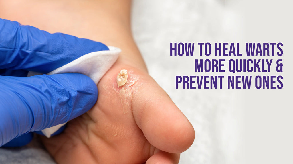 How To Heal Warts More Quickly