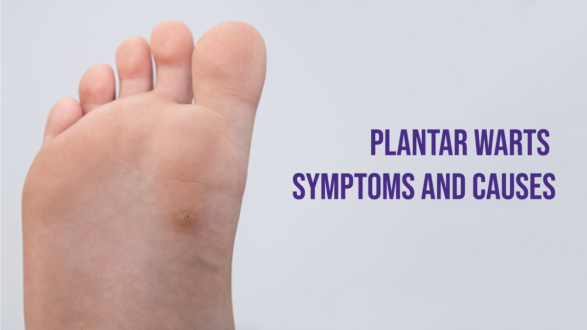 Foot Plantar Wart Treatment Plantar Warts Symptoms And Cause Foot plantar wart treatment plantar warts symptoms and cause