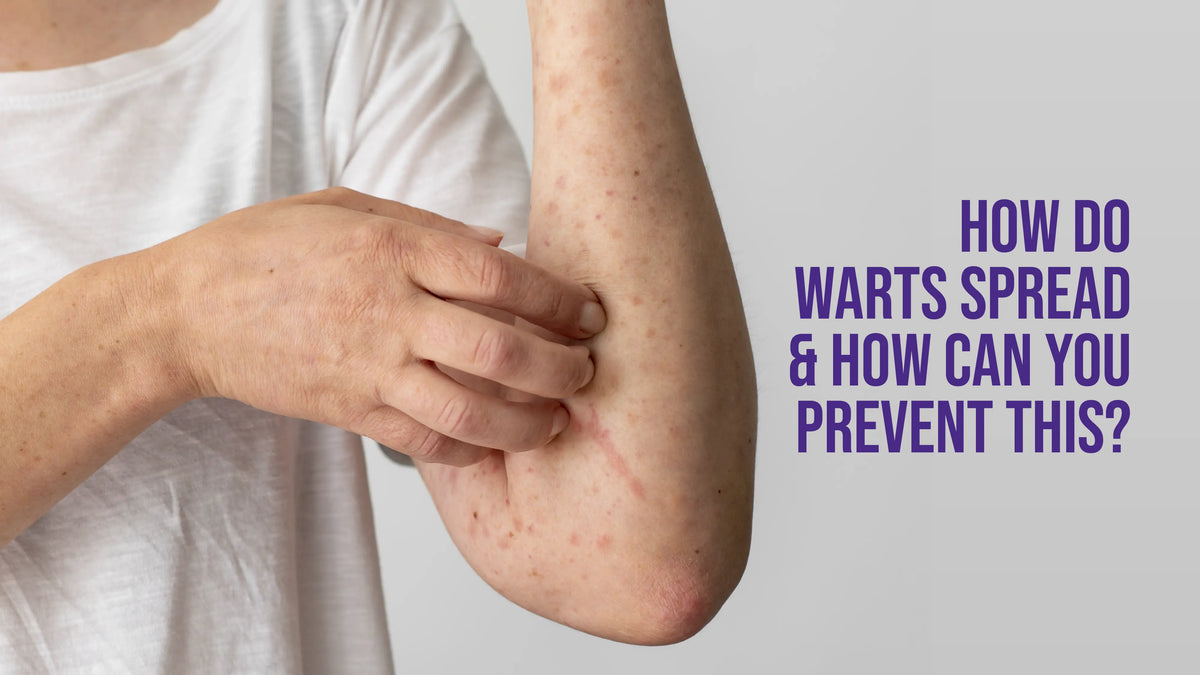 How Do Warts Spread and How Can You Prevent This? Wart Wizard